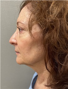 Facelift Before Photo by Franklin Richards, MD; Bethesda, MD - Case 50066