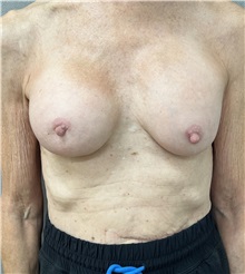 Breast Implant Revision Before Photo by Franklin Richards, MD; Bethesda, MD - Case 50087 Breast Implant Revision Before Photo by Franklin Richards, MD; Bethesda, MD - Case 50087