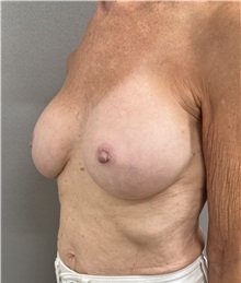Breast Implant Revision After Photo by Franklin Richards, MD; Bethesda, MD - Case 50087