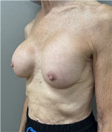 Breast Implant Revision Before Photo by Franklin Richards, MD; Bethesda, MD - Case 50087