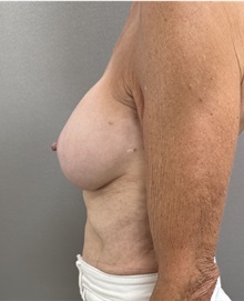 Breast Implant Revision After Photo by Franklin Richards, MD; Bethesda, MD - Case 50087