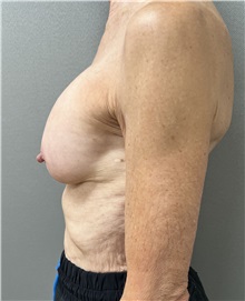 Breast Implant Revision Before Photo by Franklin Richards, MD; Bethesda, MD - Case 50087
