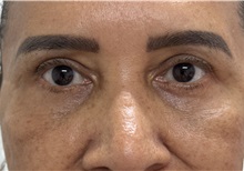 Eyelid Surgery After Photo by Franklin Richards, MD; Bethesda, MD - Case 50090 Eyelid Surgery After Photo by Franklin Richards, MD; Bethesda, MD - Case 50090