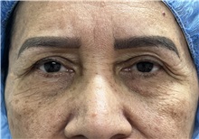 Eyelid Surgery Before Photo by Franklin Richards, MD; Bethesda, MD - Case 50090 Eyelid Surgery Before Photo by Franklin Richards, MD; Bethesda, MD - Case 50090