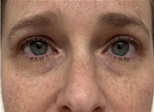 Eyelid Surgery After Photo by Franklin Richards, MD; Bethesda, MD - Case 50147