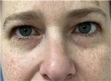 Eyelid Surgery Before Photo by Franklin Richards, MD; Bethesda, MD - Case 50147