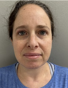 Liposuction After Photo by Franklin Richards, MD; Bethesda, MD - Case 50148
