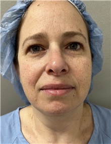 Liposuction Before Photo by Franklin Richards, MD; Bethesda, MD - Case 50148