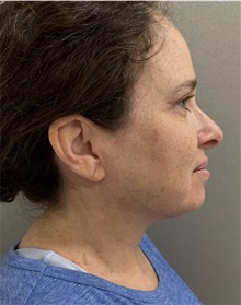 Liposuction After Photo by Franklin Richards, MD; Bethesda, MD - Case 50148