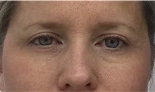 Eyelid Surgery After Photo by Franklin Richards, MD; ,  - Case 50223 Eyelid Surgery After Photo by Franklin Richards, MD; ,  - Case 50223