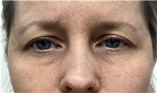 Eyelid Surgery Before Photo by Franklin Richards, MD; ,  - Case 50223 Eyelid Surgery Before Photo by Franklin Richards, MD; ,  - Case 50223