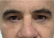 Eyelid Surgery After Photo by Franklin Richards, MD; ,  - Case 50236