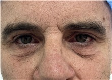 Eyelid Surgery Before Photo by Franklin Richards, MD; ,  - Case 50236