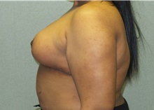 Breast Reduction After Photo by Benjamin Van Raalte, MD; Davenport, IA - Case 35992