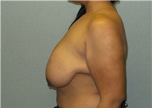 Breast Reduction Before Photo by Benjamin Van Raalte, MD; Davenport, IA - Case 35992