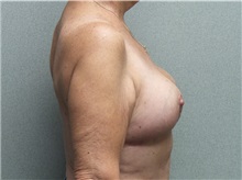 Breast Reduction After Photo by Benjamin Van Raalte, MD; Davenport, IA - Case 35997