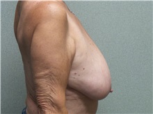 Breast Reduction Before Photo by Benjamin Van Raalte, MD; Davenport, IA - Case 35997