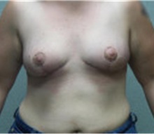 Breast Lift After Photo by Benjamin Van Raalte, MD; Davenport, IA - Case 36000
