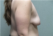 Breast Lift Before Photo by Benjamin Van Raalte, MD; Davenport, IA - Case 36000