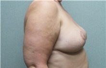 Breast Lift After Photo by Benjamin Van Raalte, MD; Davenport, IA - Case 36004