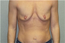 Breast Augmentation Before Photo by Benjamin Van Raalte, MD; Davenport, IA - Case 36676
