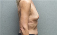 Breast Augmentation Before Photo by Benjamin Van Raalte, MD; Davenport, IA - Case 36677