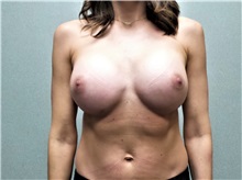 Breast Augmentation After Photo by Benjamin Van Raalte, MD; Davenport, IA - Case 37684