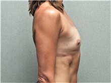 Breast Augmentation Before Photo by Benjamin Van Raalte, MD; Davenport, IA - Case 37684