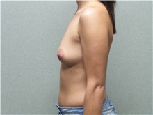 Breast Augmentation Before Photo by Benjamin Van Raalte, MD; Davenport, IA - Case 38907
