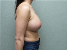Breast Augmentation After Photo by Benjamin Van Raalte, MD; Davenport, IA - Case 38907