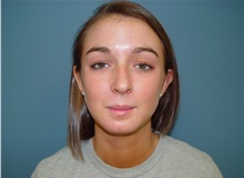 Chin Augmentation After Photo by Ram Kalus, MD; ,  - Case 28211