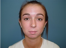 Chin Augmentation Before Photo by Ram Kalus, MD; ,  - Case 28211