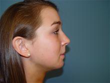 Chin Augmentation After Photo by Ram Kalus, MD; ,  - Case 28211
