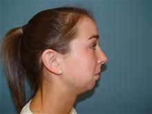 Chin Augmentation Before Photo by Ram Kalus, MD; ,  - Case 28211