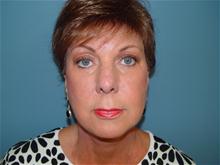 Facelift After Photo by Ram Kalus, MD; ,  - Case 28483