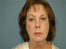 Facelift Before Photo by Ram Kalus, MD; ,  - Case 28483