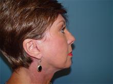 Facelift After Photo by Ram Kalus, MD; ,  - Case 28483