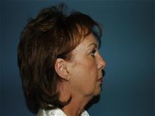 Facelift Before Photo by Ram Kalus, MD; ,  - Case 28483