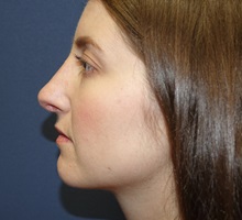 Rhinoplasty After Photo by Ram Kalus, MD; Mount Pleasant, SC - Case 30667