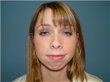 Chin Augmentation Before Photo by Ram Kalus, MD; Mount Pleasant, SC - Case 30685