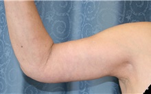 Arm Lift After Photo by Sherif Khattab, MD; Torrance, CA - Case 24516