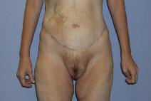 Body Contouring After Photo by Constance Barone, MD; San Antonio, TX - Case 7606