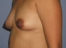 Breast Augmentation Before Photo by Constance Barone, MD; San Antonio, TX - Case 7607
