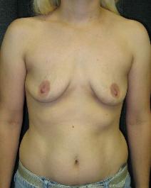 Breast Augmentation Before Photo by Constance Barone, MD; San Antonio, TX - Case 9282