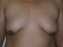 Breast Lift Before Photo by Constance Barone, MD; San Antonio, TX - Case 9283