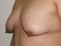 Breast Lift Before Photo by Constance Barone, MD; San Antonio, TX - Case 9283