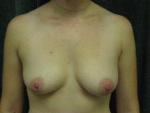 Breast Augmentation Before Photo by Constance Barone, MD; San Antonio, TX - Case 9287