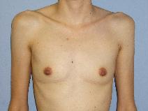 Breast Augmentation Before Photo by Constance Barone, MD; San Antonio, TX - Case 9288