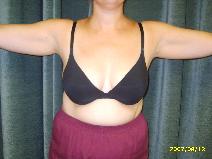 Liposuction Before Photo by Constance Barone, MD; San Antonio, TX - Case 9289