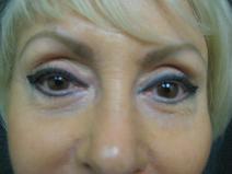 Eyelid Surgery After Photo by Constance Barone, MD; San Antonio, TX - Case 9304